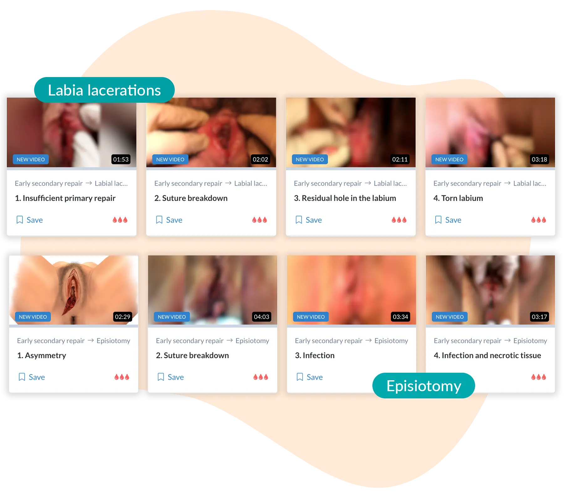 Early-secondary repair-clinical-cases Assessment of healing in labial tears