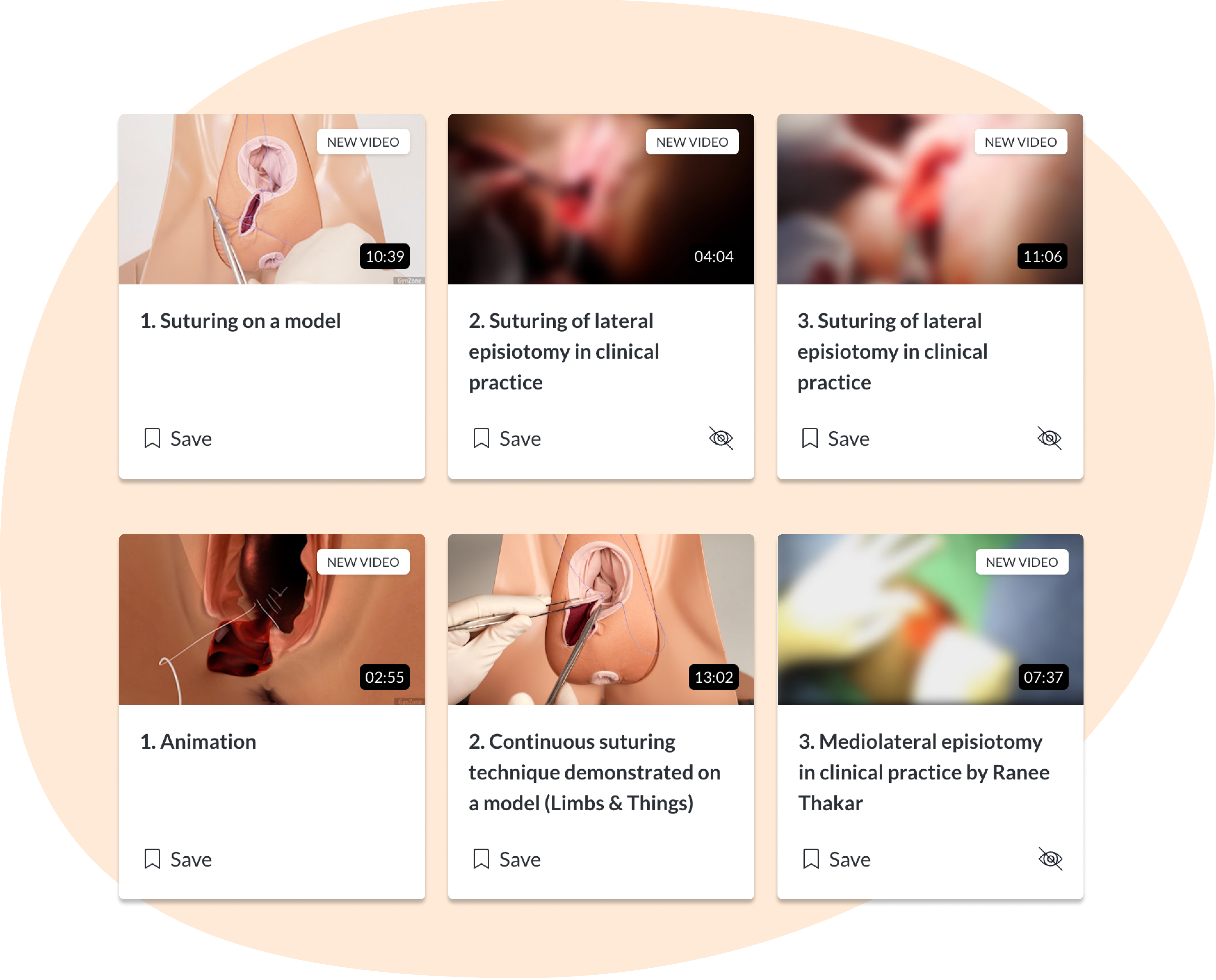 Epiriotomy repair_ course features Assessment of healing in labial tears