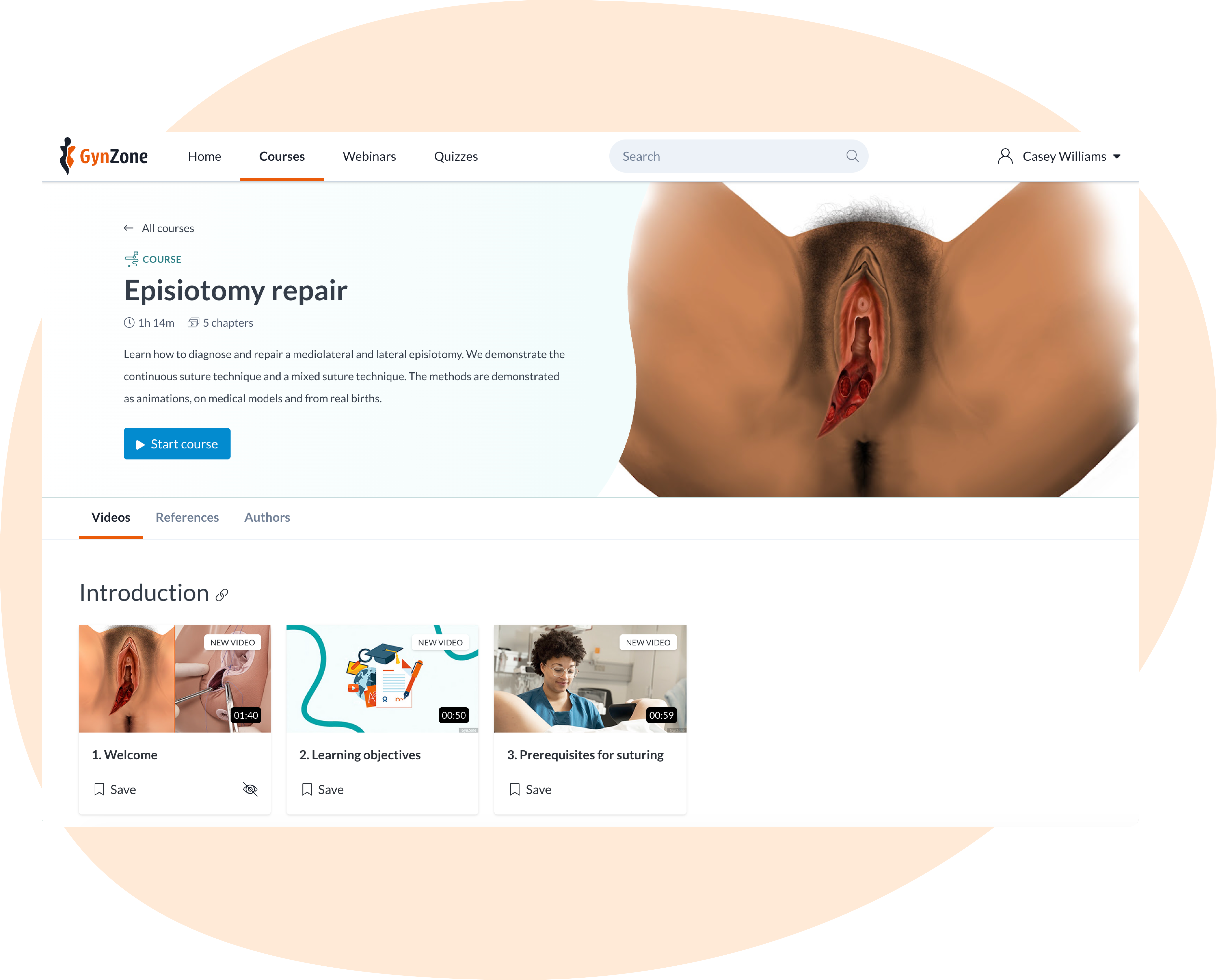 Episiotomy repair course page Assessment of healing in labial tears