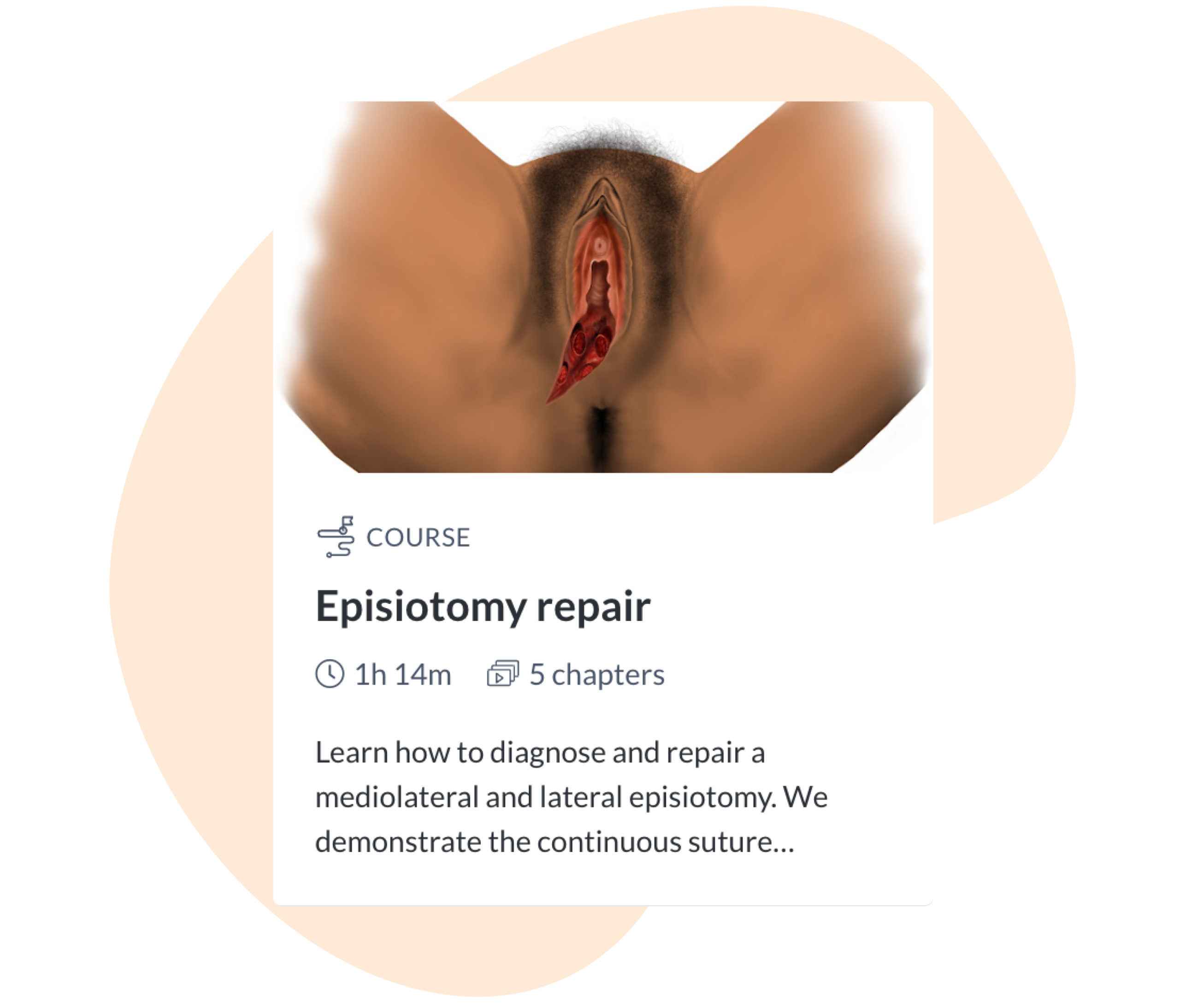 Hero episiotomy repair
