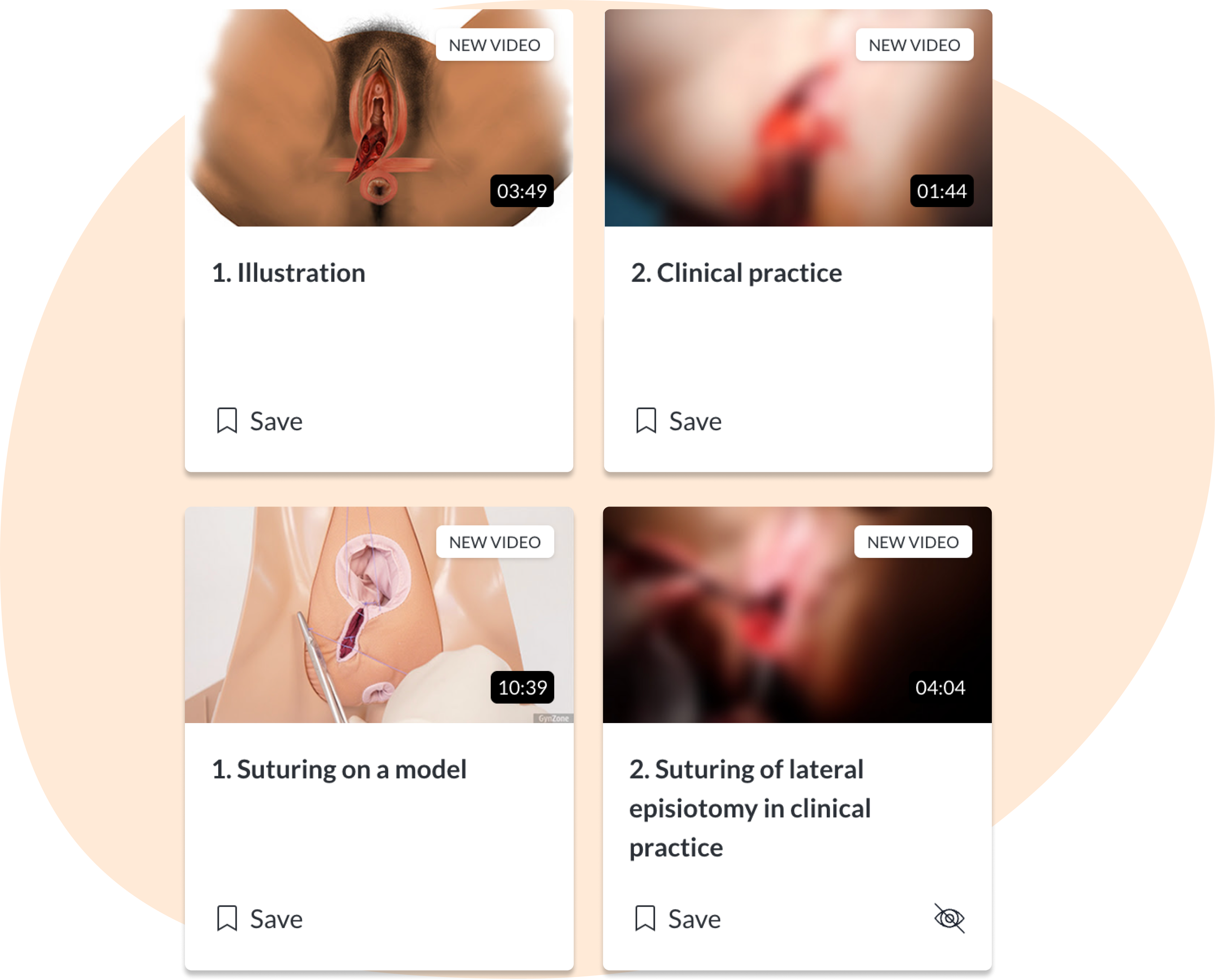 How to repair an episiotomy Course overview of early secondary repair of 2nd degree lacerations
