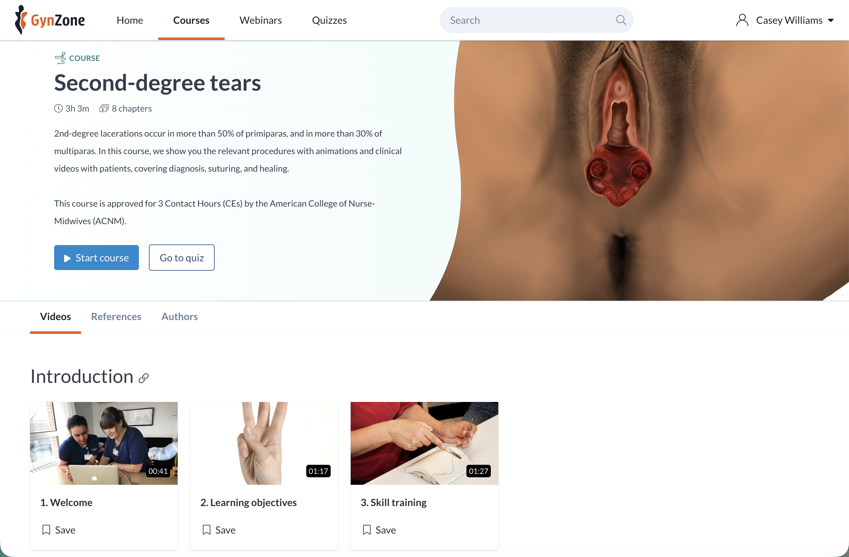 Second degree tears course
